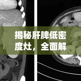 揭秘肝脾低密度灶，全面解讀，助你從容應(yīng)對(duì)疾病
